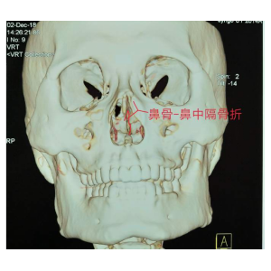 貴陽銘仁耳鼻喉醫(yī)院提醒您：鼻子很脆弱，要好好保護(hù)