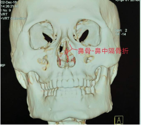 十歲小孩被書本砸破鼻子，(圖1)