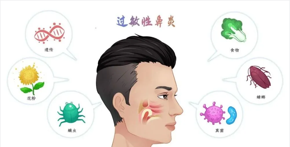 銘仁耳鼻喉專家分享：如何一招解決過敏性鼻炎的打噴嚏流鼻涕！(圖1)