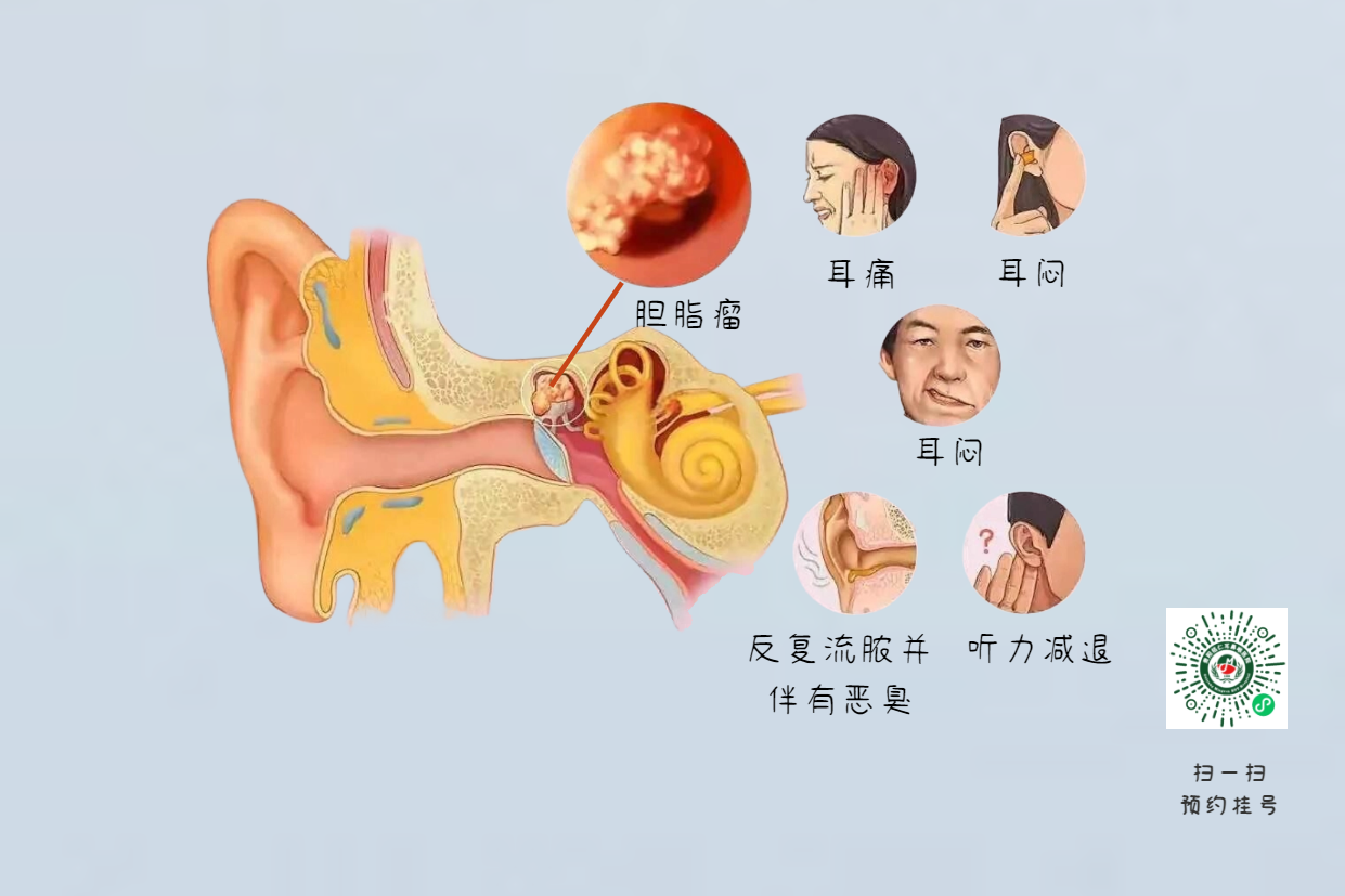 手術(shù)沒做干凈，術(shù)后3年顱內(nèi)竟發(fā)現(xiàn)巨大膽脂瘤！(圖6)