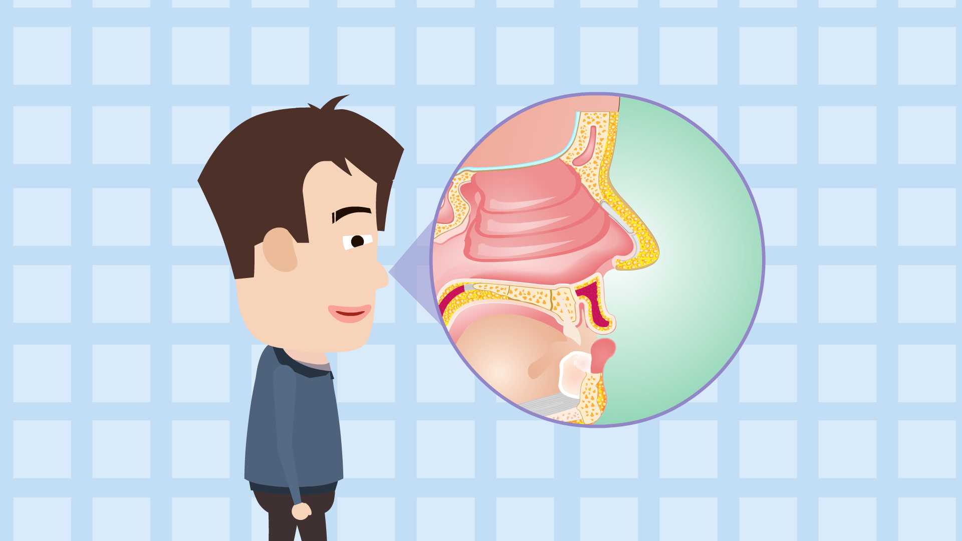 鼻息肉,鼻腔內的“不速之客”(圖1)
