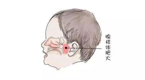 鼻息肉,鼻腔內的“不速之客”(圖2)