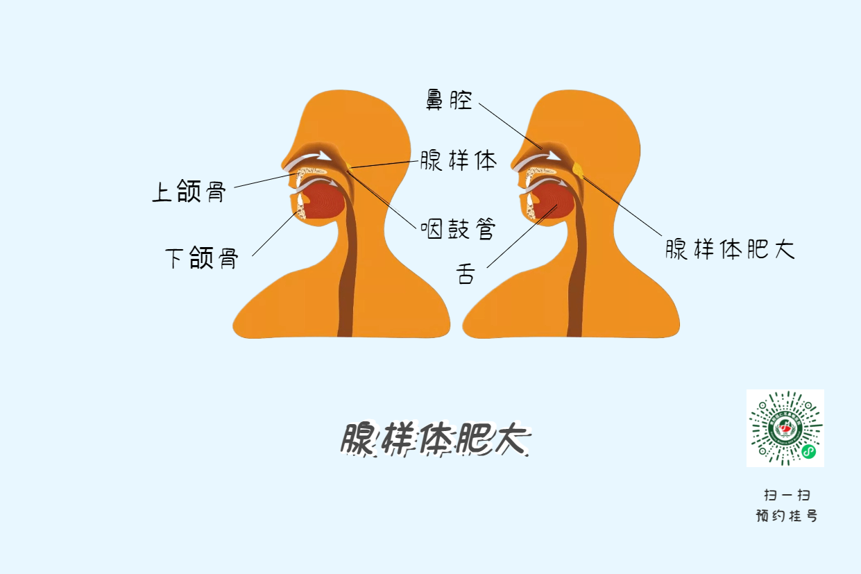 暑假來(lái)了，孩子腺樣體肥大到底切不切？(圖4)