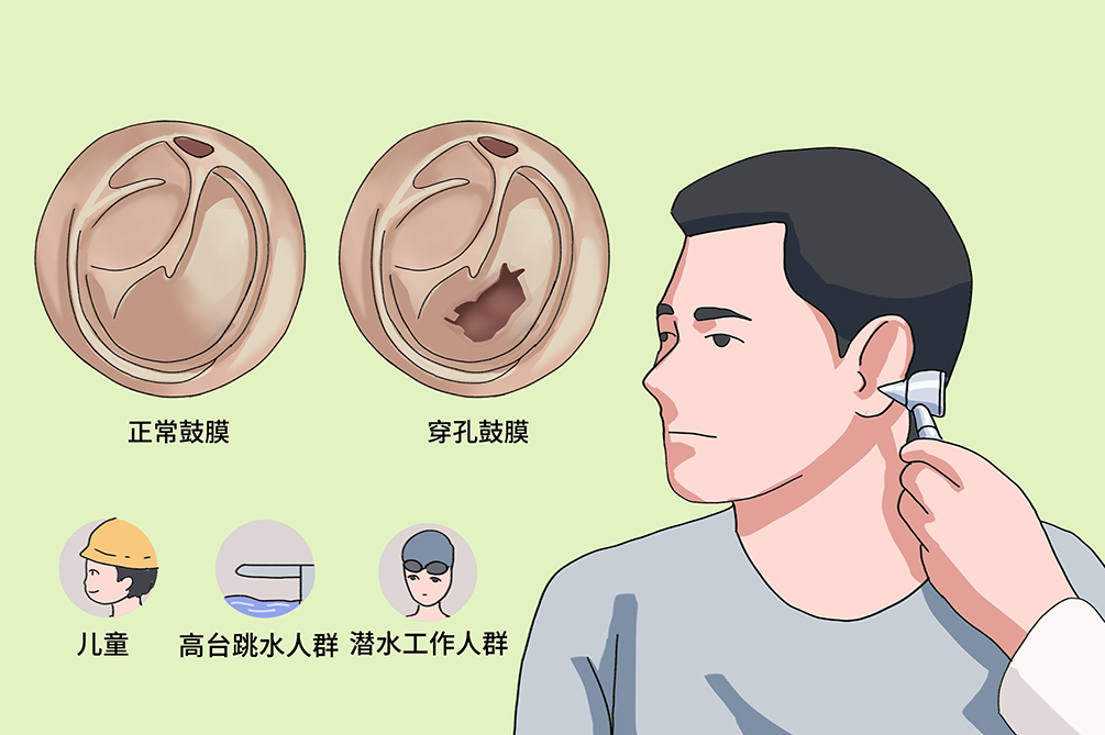 鼓膜穿孔不及時治療，會導致聽力下降，甚至引發(fā)顱內感染？(圖3)