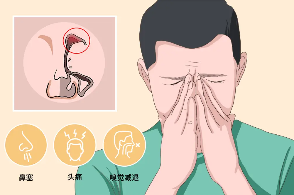 鼻竇炎不是小病，拖延治療，當(dāng)心三大并發(fā)癥！(圖1)