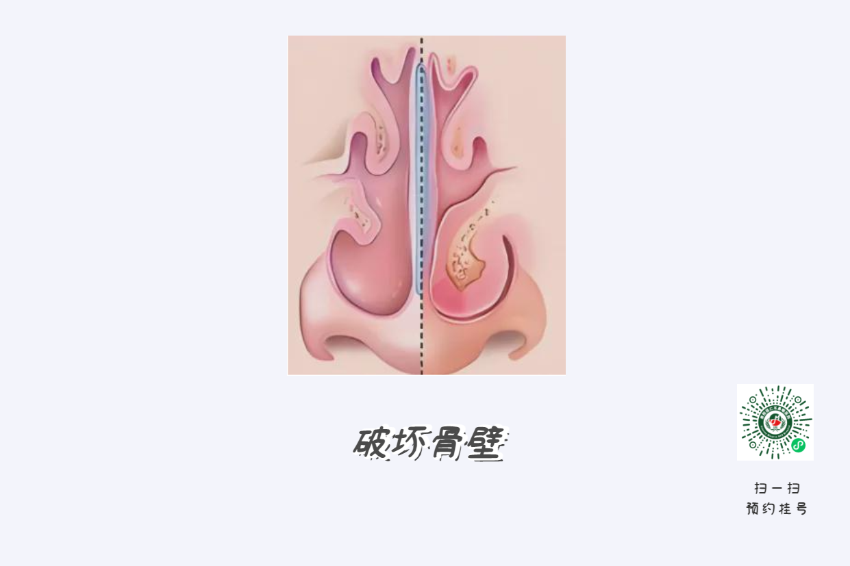 患上鼻竇炎不可小覷，當(dāng)心五大并發(fā)癥！(圖2)