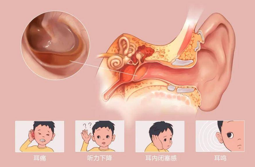 耳鼻喉專家分享：孩子聽力下降？這些疾病不能拖！(圖1)