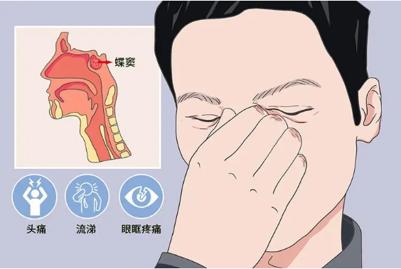 頭疼、眼痛雖小，卻可能是蝶竇炎發(fā)出的警告信號！(圖1)