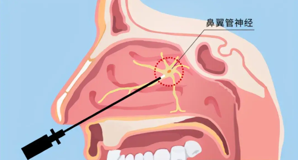 頭疼、眼痛雖小，卻可能是蝶竇炎發(fā)出的警告信號！(圖2)