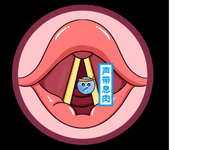 聲帶息肉，就像是聲帶長出了一個“小肉球”(圖2)