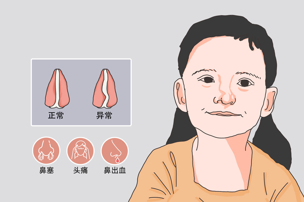鼻中隔偏曲會(huì)導(dǎo)致睡眠障礙，甚至誘發(fā)心血管疾?。?圖2)