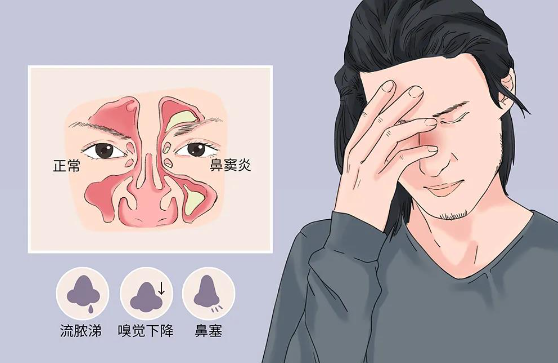鼻竇炎不及時(shí)治療，會(huì)危及生命？？？(圖2)