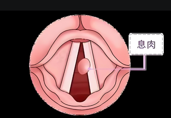 聲音嘶啞、嗓子難受，聲帶息肉不可小覷(圖1)