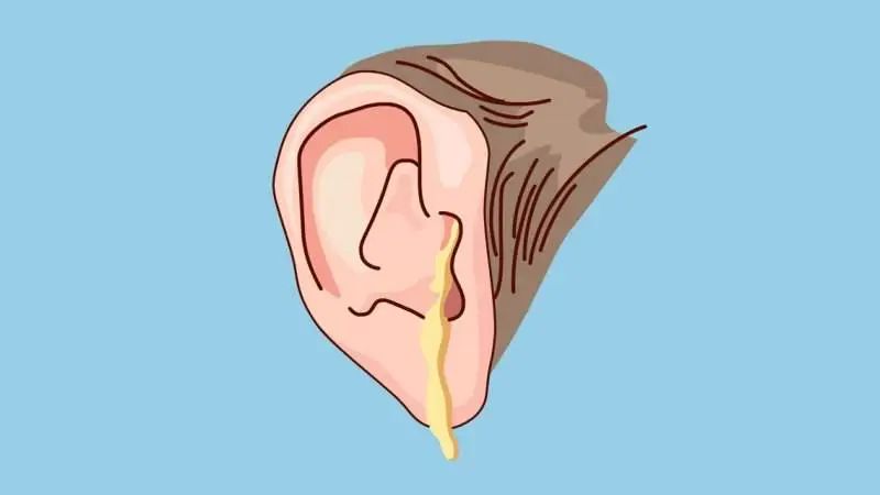 耳朵流膿、耳痛、聽(tīng)力下降？中耳炎及時(shí)治療會(huì)怎樣？(圖2)