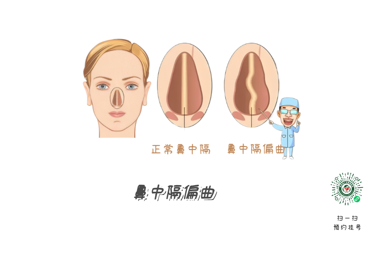 鼻塞、流涕、打噴嚏，是鼻炎引起的？注意可能是鼻中隔偏曲！(圖1)