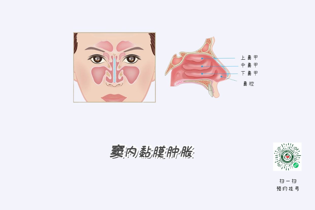 鼻竇炎頭痛有特點！這個位置痛要當(dāng)心(圖4)