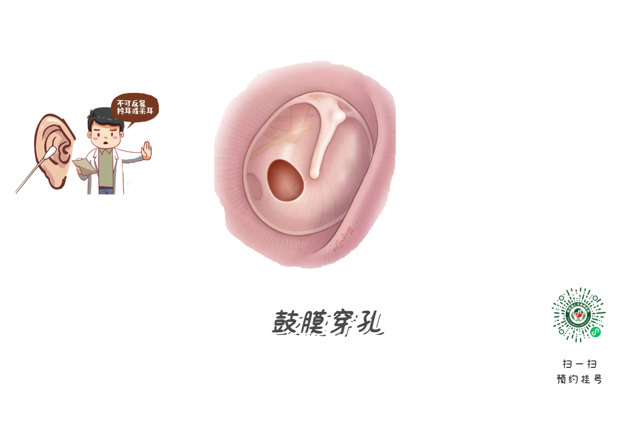 掏耳朵竟致顱內(nèi)感染？這5個習慣快改掉(圖2)