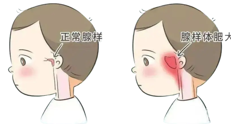 孩子腺樣體肥大影響發(fā)育和容貌，趁五一假期，微創(chuàng)治療快速治愈！(圖1)
