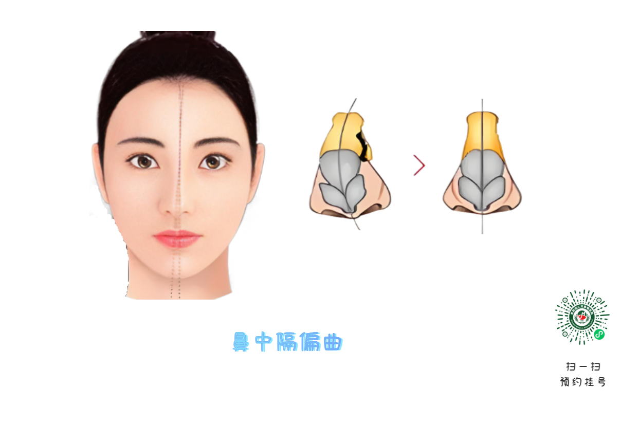 鼻中隔偏曲必須手術(shù)？符合這標(biāo)準(zhǔn)再?zèng)Q定(圖1)