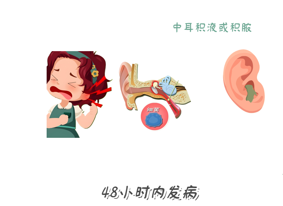 耳朵痛到睡不著？急性中耳炎急救法！(圖2)